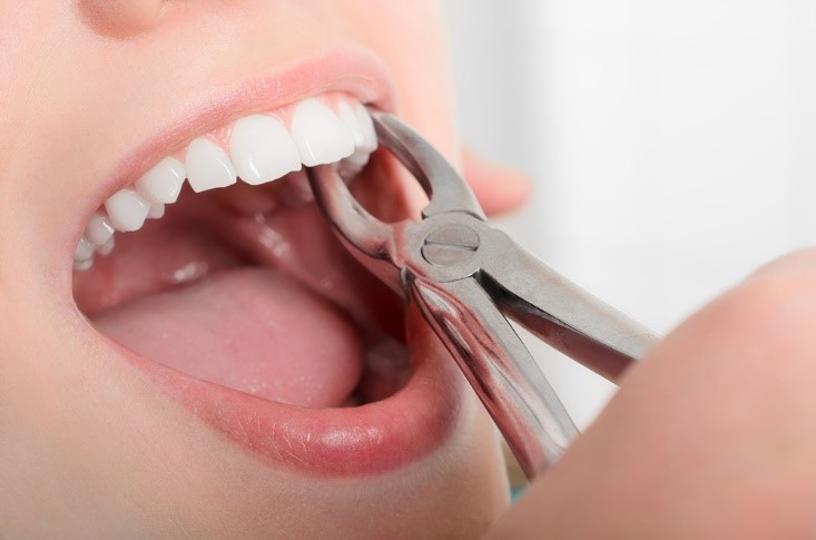 Tooth Extraction (Simple)