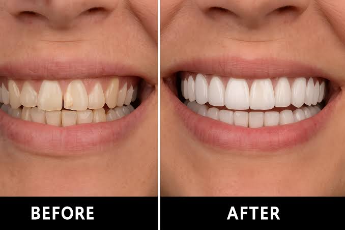 Dental Veneers