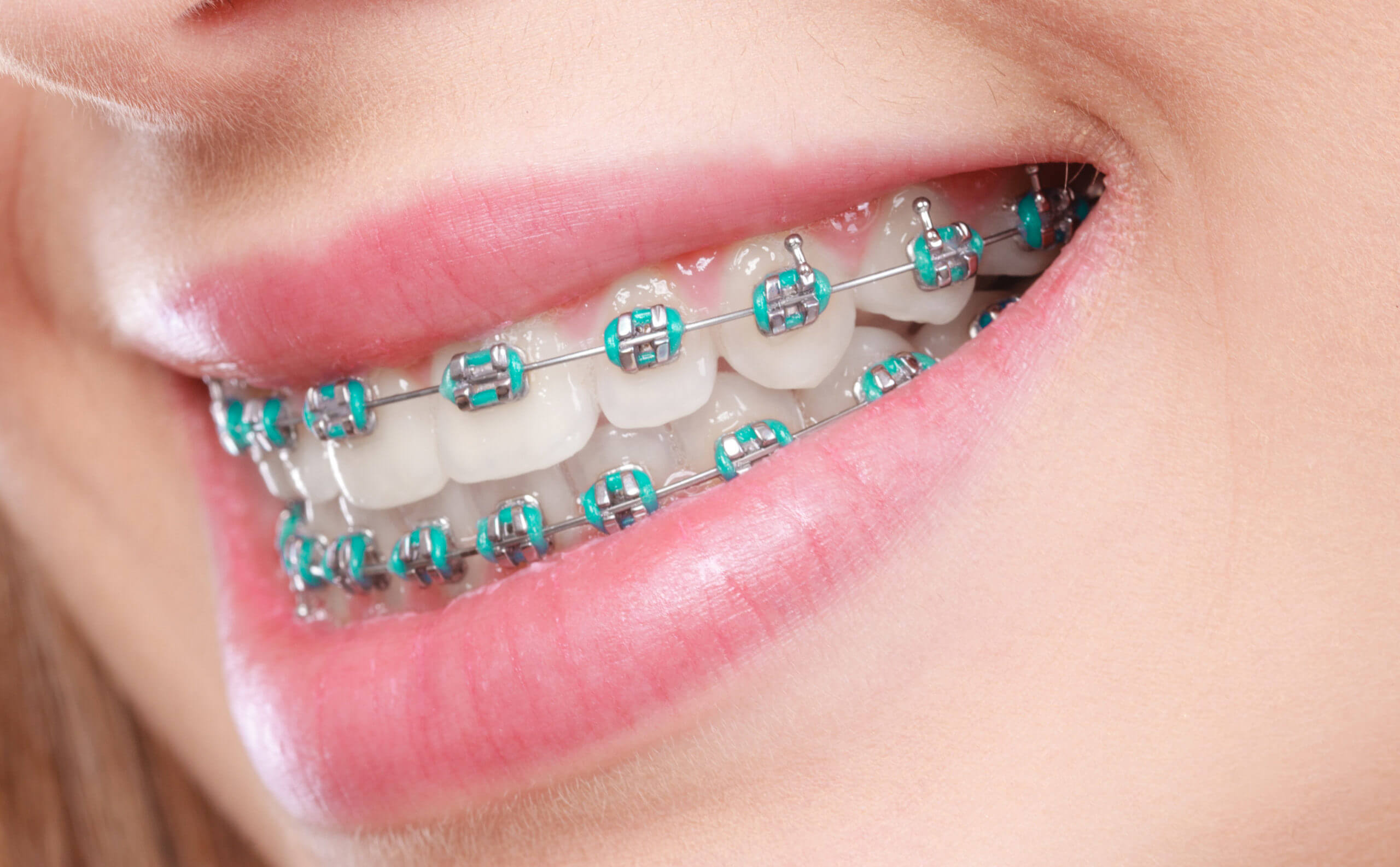 Braces Consultation & Installation